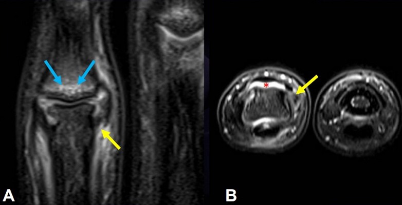 Partial tear of the collateral ligament following trauma during soccer training in a 15 year old male goalkeeper with left finger pain