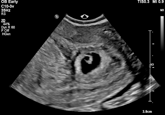 Intrauterine gestational sac with foetal pole