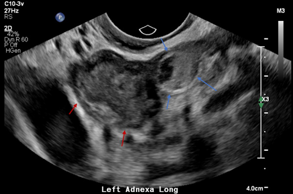 Left adnexal heterogeneous mass with an echogenic tubal ring sign adjacent to the left ovary