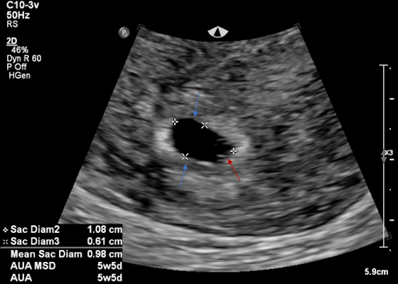 Intrauterine gestational sac and yolk sac