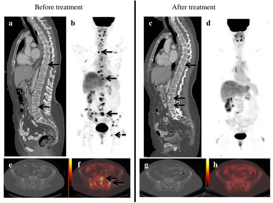 86-year-old woman with metastatic breast cancer before and after first-line endocrine therapy combined with bevacizumab shows stable disease by contrast-enhanced -CT and complete response by PET/CT