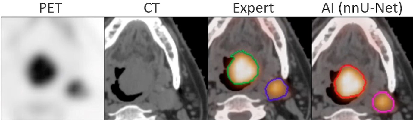 A successful segmentation by AI of head and neck tumor lesions from PET/CT images