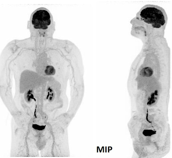Ultralow-dose scan on Biograph Vision Quadra PET/CT