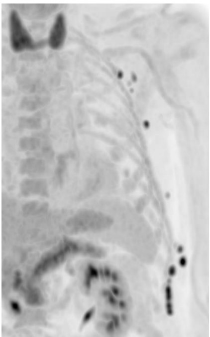 PET in a patient with lymph node metastatic disease from malignant melanoma