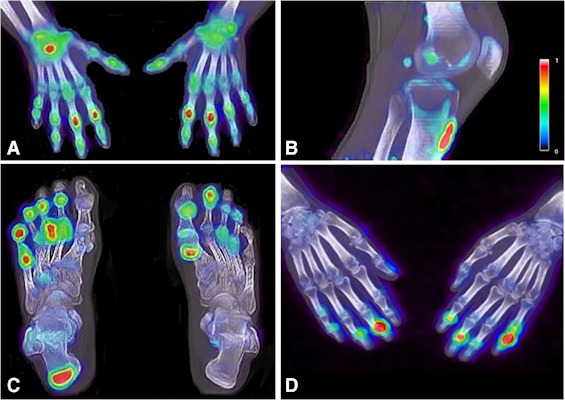 F-18 NaF enhancement in the right wrist and proximal interphalangeal joints of the hands