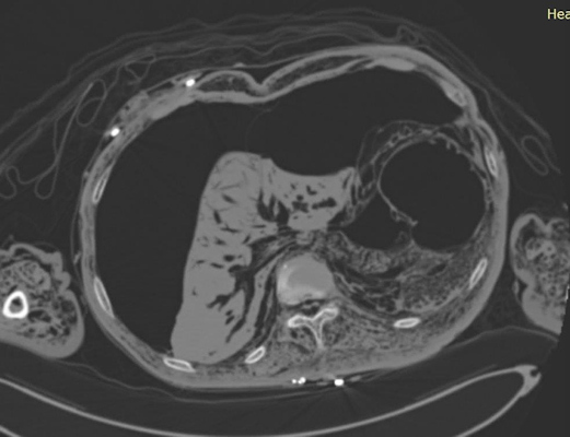 CT image shows severe decomposition of the abdomen