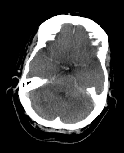 Normal postmortem brain CT with pseudosubarachnoid hemorrhage sign