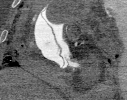 CT image shows Type A aortic dissection
