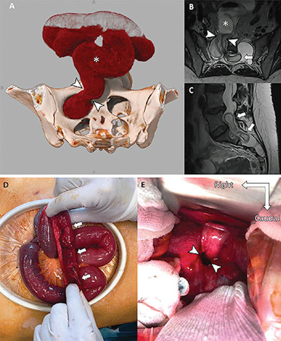 Images of a 38 year old woman with Marfan syndrome who was diagnosed with intradural small bowel herniation through a torn right S1 dural ectasia