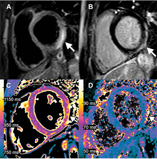 Images of a 15 year old boy with myocarditis after COVID 19 vaccination