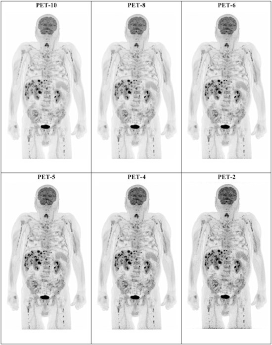 Example of maximum intensity projection F 18 FDG PET images of a 74 year old man with stage IV cutaneous melanoma planned for treatment with immune checkpoint inhibitors