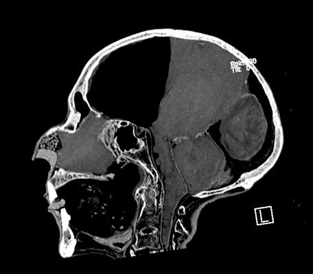 A sagittal 2D CT image of Ramesses II head shows his prominent high nasal bone