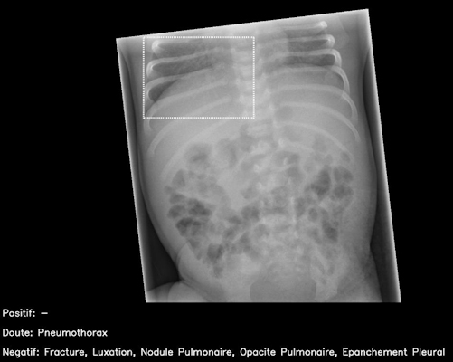 Normal pediatric abdominal radiograph interpreted by AI candidate as having right basal pneumothorax with dashed bounding box