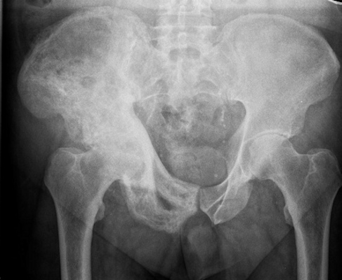 Abnormal adult pelvic radiograph shows increased sclerosis and expansion of right iliac bone in keeping with Pagets disease