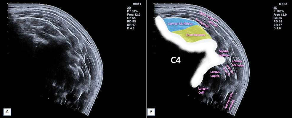 B mode ultrasound imaging shows short rotator