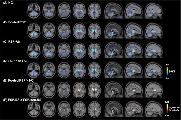F 18 Florzolotau PET images of patients with progressive supranuclear palsy