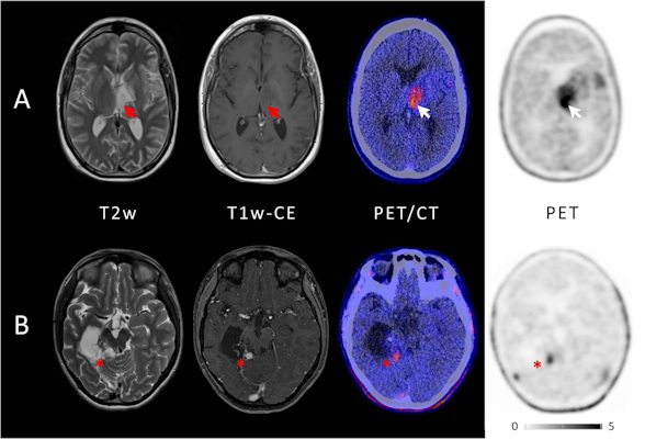 Example of two patients with concordant imaging results and incremental diagnostic value of F 18 FET PET