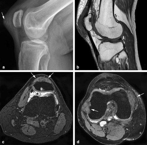 55 year old man with differential diagnosis of gout in the knee