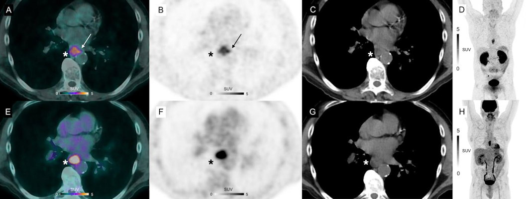 axial views of a primary lesion in a 53 year old participant with esophageal squamous cell carcinoma