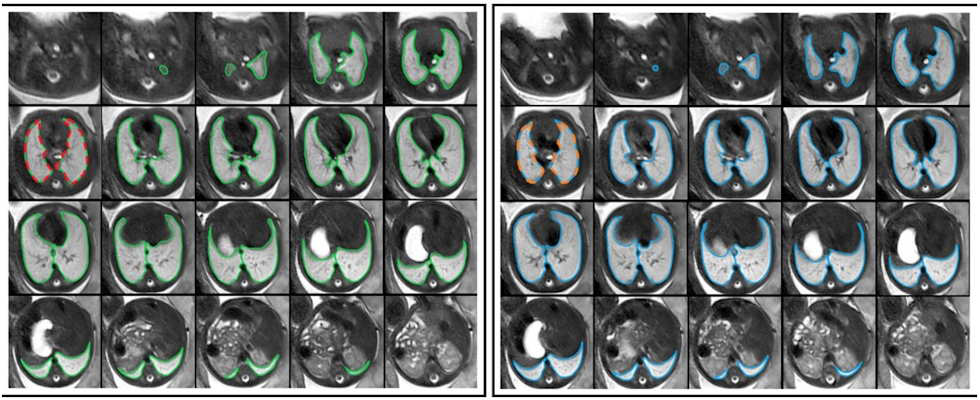 Repeated acquisitions of T2 weighted axial MRI images of the lung in a fetus at gestational week 32
