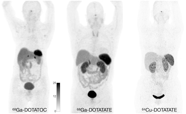Normal biodistribution in patients of the radiotracers Ga-68 DOTATOC