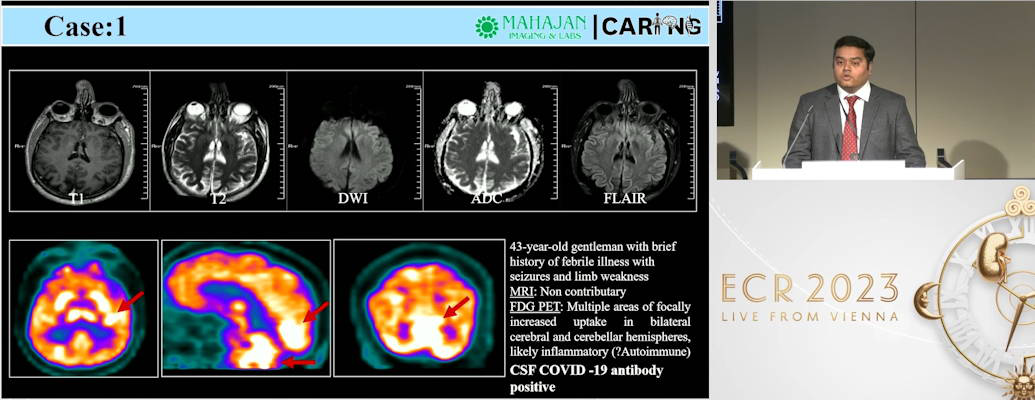 brain imaging findings in patients with COVID