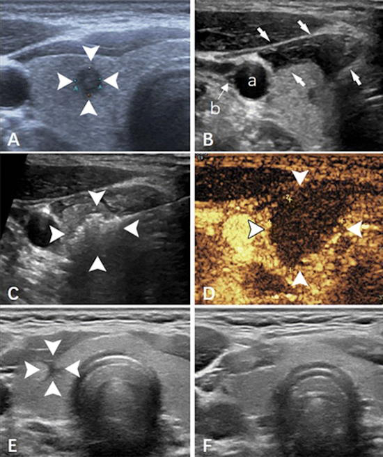 Ultrasound images show papillary thyroid carcinoma in the right lobe of the thyroid in a 36 year old man