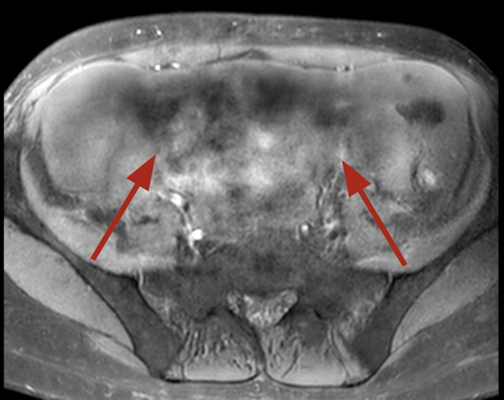 Dielectric artifact. Axial echo gradient fat saturated T1 weighted slice of the abdomen acquired on a 3 tesla device