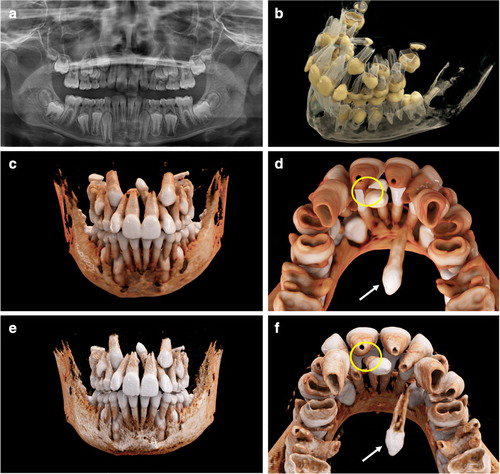 An 11 year old boy with a mesiodens and a supplementary tooth within the hard palate