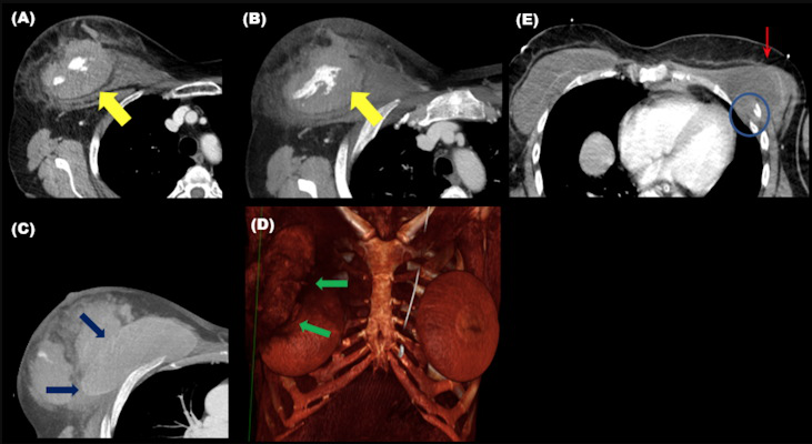 изображения травмы грудной клетки показывают пациентку с гематомой молочной железы с активным кровотечением