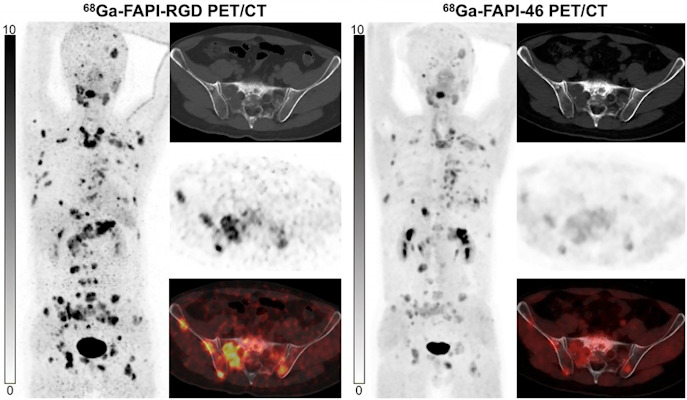 Ga 68 FAPI RGD PET CT shows significantly higher radiotracer uptake than Ga 68 FAPI 46 in patient with metastatic thyroid cancer