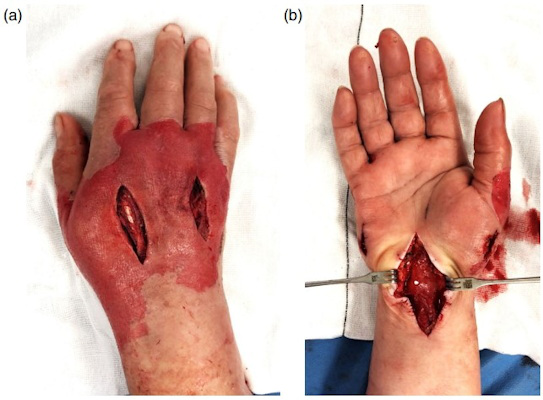 Fasciotomy incisions to the dorsal compartments of the hand