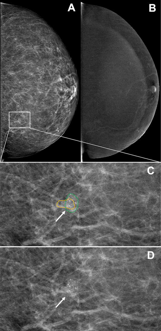 Примеры изображений показывают маммограммы с контрастным усилением правильного обнаружения подозрительных кальцинатов с помощью модели глубокого обучения.