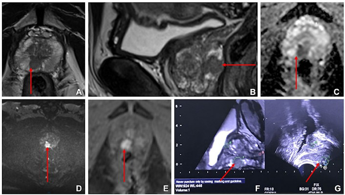 Images from multiparametric MRI of the prostate in a 60 year old male participant show a focal lesion (arrow) in the right peripheral zone of the prostate at the mid gland level