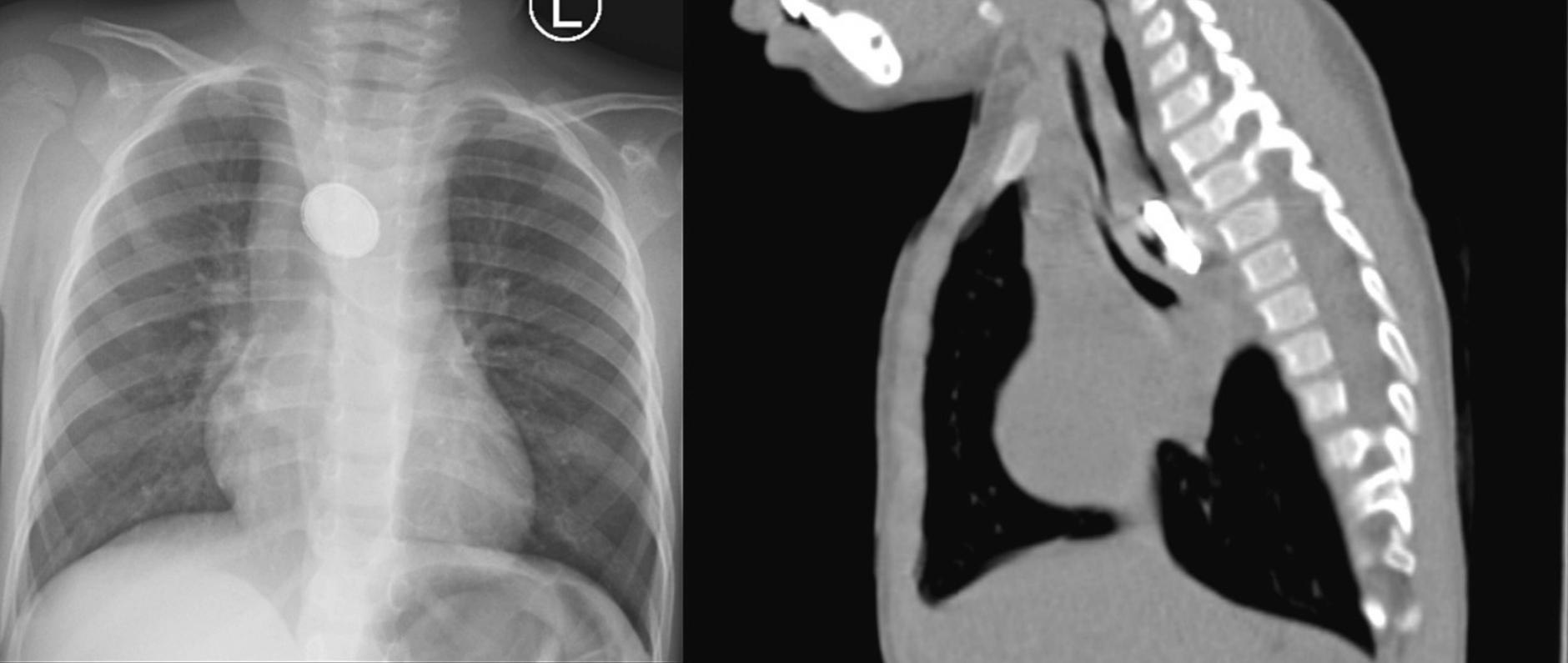 Posteroanterior chest x-ray and sagittal view of the thoracic CT revealing a foreign body in the thoracic esophagus