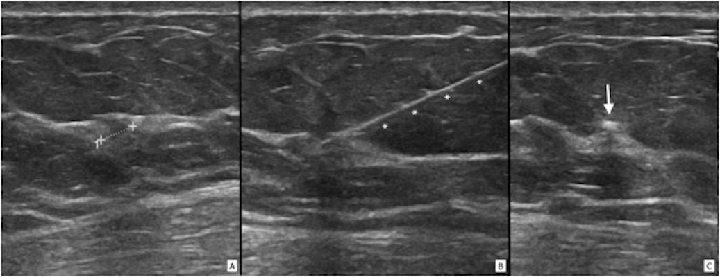 Ultrasound-guided Magseed localization of a nonpalpable lesion