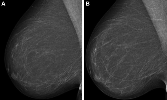 Full field digital mammograms in a 59 year old woman show the screening mammogram obtained during the study period