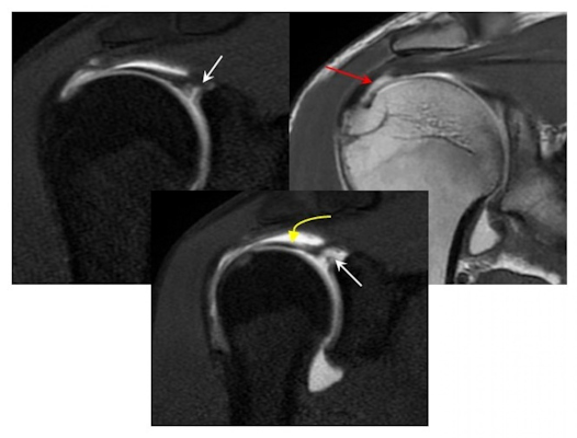 After lifting weights at the gym a 33 year old man presented with a partial articular supraspinatus tendon avulsion with superior labral anterior posterior tear