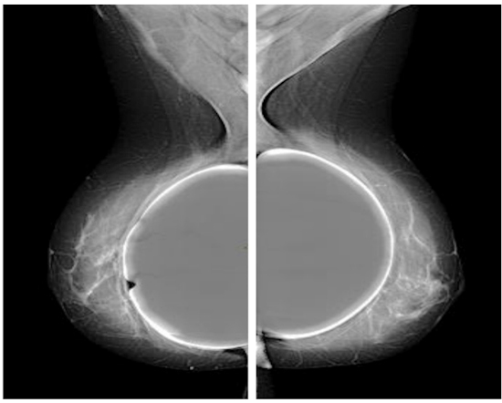 Mediolateral oblique view full field digital mammography of patient with breast implants using the exposure control algorithm