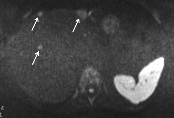 Esta imagen ponderada por difusión obtenida durante un protocolo corto muestra a un paciente con metástasis hepáticas evidentes