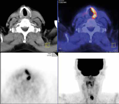 70-year-old man with thyroid cancer