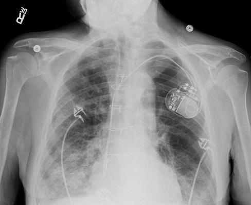 Adult chest with pacemaker imaged using the Helix advanced processing tool
