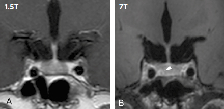 Compared with low-field MRI, 7-tesla MRI in 16 patients resulted in three newly detected pituitary lesions (shown by the white arrow)