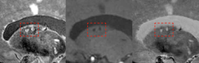 7-tesla MRI can detect the total burden of larger and smaller infarcts, including small microinfarcts in the deep gray matter (shown here inside red frames)