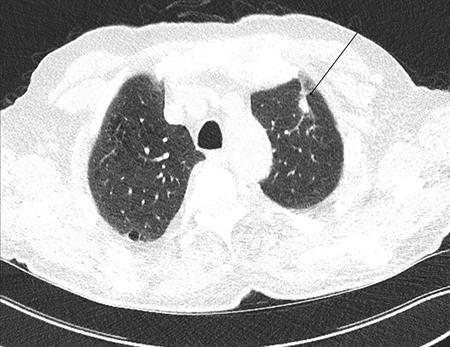 Cancer in the left upper lobe