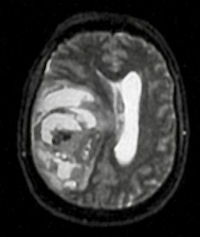 autopsy_MRI