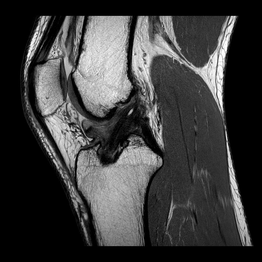 Sagittal MR image shows wad of arthrofibrosis in the intercondylar notch