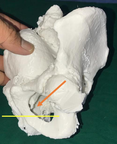 3D-printed model of the pelvis based on patient CT scans