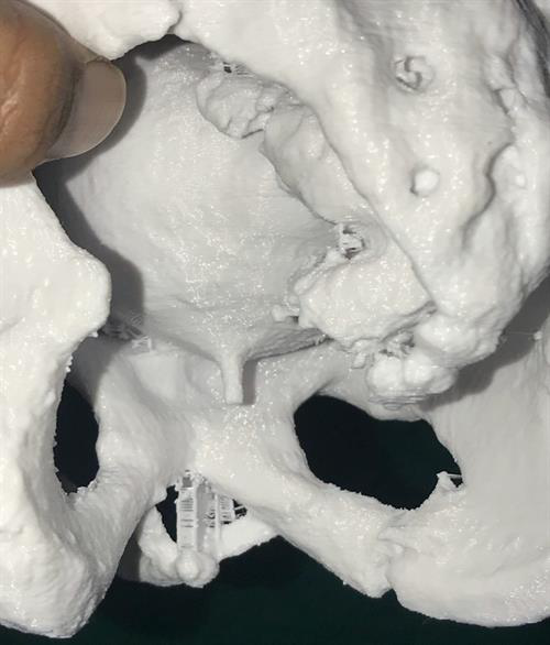 A posterior view of the 3D-printed model showing the posterior urethra in relation to the inferior margin of the pubic bone