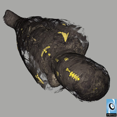 The wrapped mummy imaged from the CT scans showing the visible amulets using Fovia software.